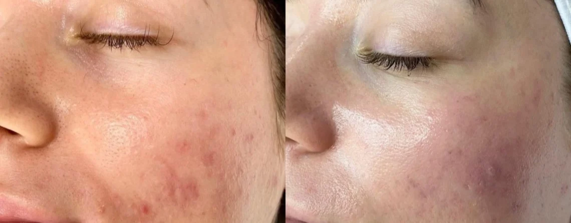 Как лечить акне с Hydrafacial