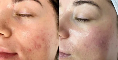 Как лечить акне с Hydrafacial