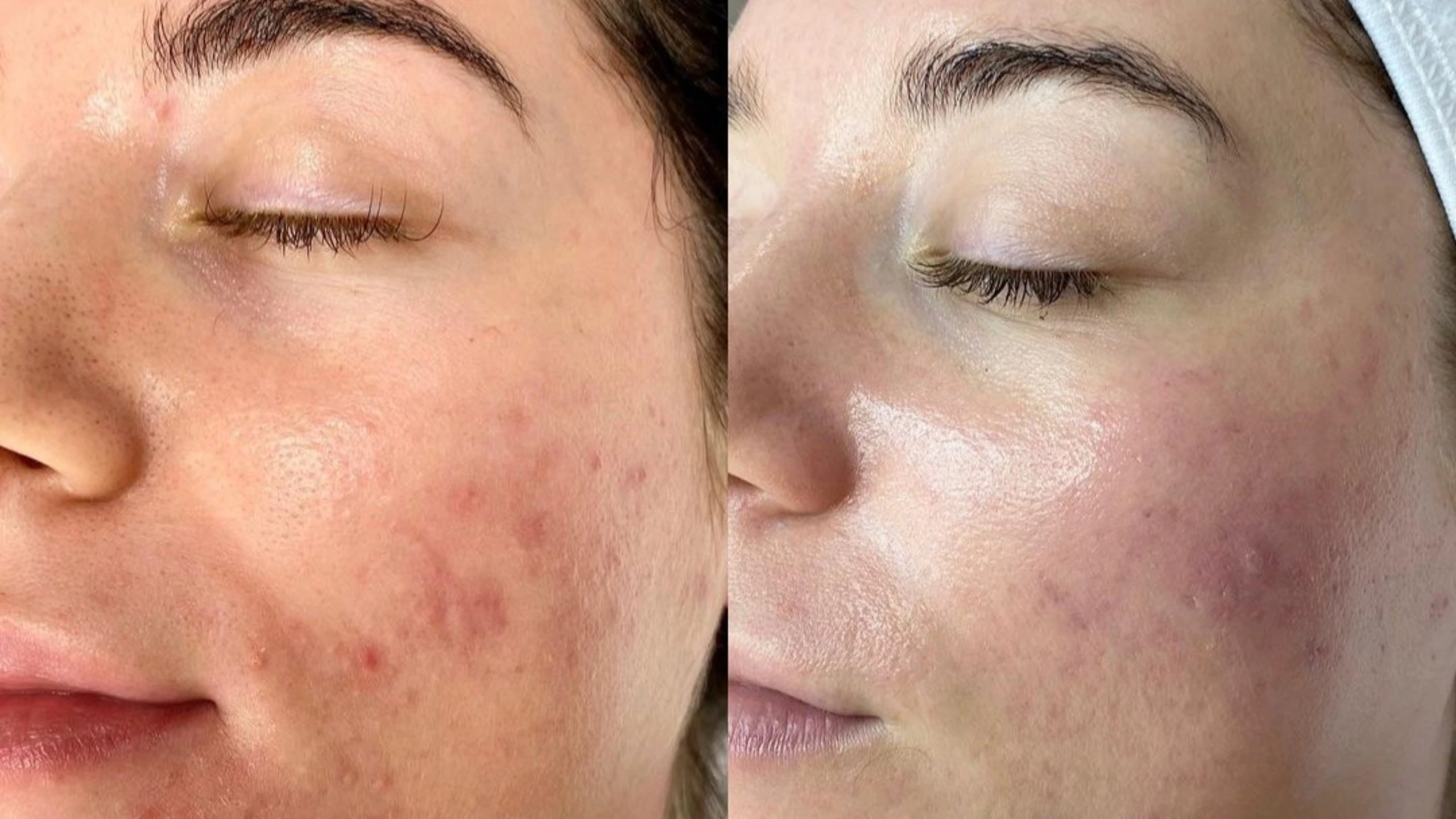 Как лечить акне с Hydrafacial